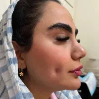 فیلر بوتاکس ویژه خانم ها و آقایان ۷۰۰تا۱۵۰۰