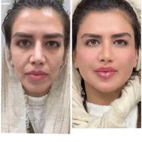 پکیج طلایی نقره ایی برنز لیفت با فیلر ژل بوتاکس