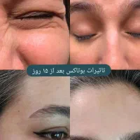 تخفیفات ویژه بوتاکس صورت و فیلر لب،فول فیس و...|خدمات آرایشگری و زیبایی|مشهد, شهید فرامرز عباسی|دیوار