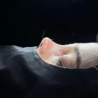 جراحی و عمل زیبایی بینی ( رینو پلاستی )