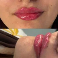 تزریق ژل و بوتاکس توسط پزشک در مطب فقط ۹۸۰