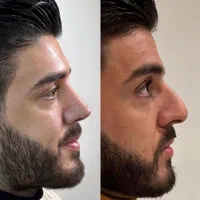 جراحی تیپ‌پلاستی بینی بصورت اقساط۱۸ ماهه