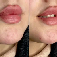 آموزش صفر تا صد زیبایی فیلر و بوتاکس و مزو تراپی