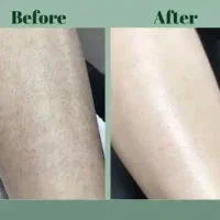 لیزر بانوان لیزر آقایان لاغری با دستگاه کویتیشن