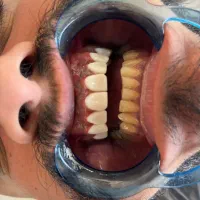 کامپوزیت دندان اقساطی بدون بهره|خدمات آرایشگری و زیبایی|اصفهان, عسگریه|دیوار