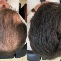 اگه ریزش مو داری پیام بده