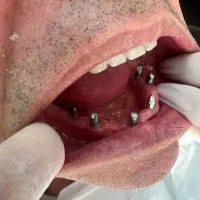 ایمپلنت قسطی، دیجیتال و حرفه ای برای لبخند ماندگار