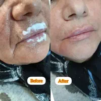 «ایرانا»دکتر کامبیز محمدپور،بوتاکس فیلر