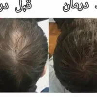 رویش مو (پی ارپی ، مزوتراپی )|خدمات آرایشگری و زیبایی|اهواز, پادادشهر|دیوار