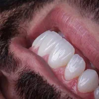 قسطی ایمپلنت و تمام خدمات دندانپزشکی بدون پیش|خدمات آرایشگری و زیبایی|اصفهان, دشتستان|دیوار