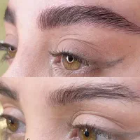 مدل میکروبلیدینگ به روش کرکی(موربروز)