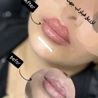 زیبایی ماندگار آرایش دائم / تزریق ژل و بوتاکس|خدمات آرایشگری و زیبایی|شوشتر, |دیوار