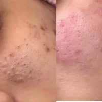 فشیال و پاکسازی جوانسازی فقط۵۰۰ الی ۵۵۰ فول دستگاه|خدمات آرایشگری و زیبایی|شاهین‌شهر, عطار|دیوار