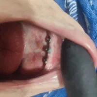 تخفیفات وشرایط اقساطی برای ایمپلنت و پروتز مصنوعی|خدمات آرایشگری و زیبایی|بجنورد, |دیوار