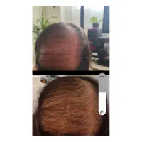 قطع ریزش مو/ رویش مجدد مو /برپایه علم نوین