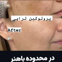 آف ۳۰% ژل بوتاکس بایوفیلر پی ارپی لاغری هایفو لیزر|خدمات آرایشگری و زیبایی|اهواز, کوی باهنر|دیوار