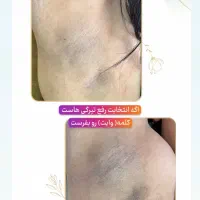 تخفیفات لیزر موهای زائد بانوان با تضمین جواب دهی