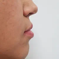 مدل ژل و بوتاکس|خدمات آرایشگری و زیبایی|قم, باسکول|دیوار