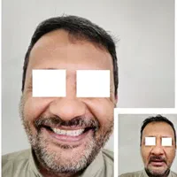 دندانسازی،دست دندان،دندان مصنوعی،پارسیل،پروتزمتحرک|خدمات آرایشگری و زیبایی|کرج, کوی مدرس|دیوار