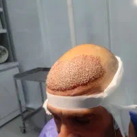 کاشت فول تراکم