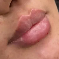 تخفیف بهاره ژل ،بوتاکس،مزو ،آنزیم