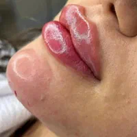 ژل و بوتاکس