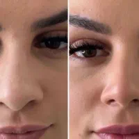 تجربه بینی خوش فرم بدون عمل و خونریزی
