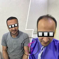 کاشت مو با شرایط اقساط تضمینی|خدمات آرایشگری و زیبایی|اردبیل, |دیوار