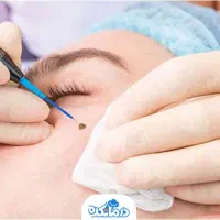 برداشتن خال و گوشت اضافی صورت و بدن