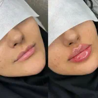 ژل لب فیلر زیرچشم،بلفاروپلاستی، فول فیس لیزر