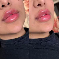 بوتاکس صورت وتزریق