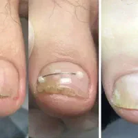 کفسابی پا.درمان ناخن پا.میخچه. ارتونیل ناخن پا|خدمات آرایشگری و زیبایی|کرج, کوی امامیه|دیوار