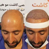 کاشت مو،کاشت ابرو،کاشت ریش با شرایط استثنایی|خدمات آرایشگری و زیبایی|تهران, دردشت|دیوار