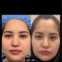 جراحی بلفارو پلاستی نیم بها|خدمات زیبایی و سلامت|تهران, فیروزآبادی|دیوار