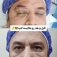 فرصت محدود بلفاروپلاستی تنها ۳.۹۹۰.۰۰۰ تومان