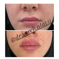 جشنواره تخفیف تزریق فیلر لب به مدت محدود توسط پزشک|خدمات آرایشگری و زیبایی|قم, دورشهر|دیوار