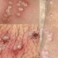 خال.زگیل.میخچه.ختنه