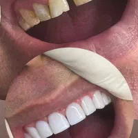 کامپوزیت دندان|خدمات آرایشگری و زیبایی|سبزوار, کاشفی شمالی (دادگستری)|دیوار