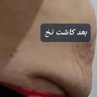 امبدینگ و ایمپلنت کاشت نخ لاغری و جوانسازی|خدمات آرایشگری و زیبایی|اصفهان, ملک|دیوار