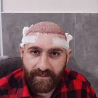 کاشت مو فقط با ۶۷۰۰