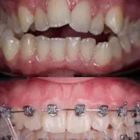 ارتودنسی به صورت تمام اقتصادی توسط متخصص