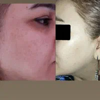ژل لاغری بعدازنتیجه حساب کن