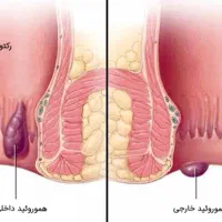 پایان درد،سوزش وخونریزی(بواسیر)