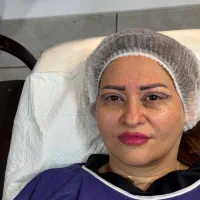 بلفارو پلاستی پلک و دایرکت ابرو ۳ قسطه