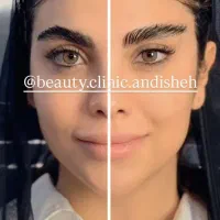 جراحی زیبایی بلفاروپلاستی،مینی لیفت صورت|خدمات آرایشگری و زیبایی|اندیشه, اندیشه فاز ۱|دیوار