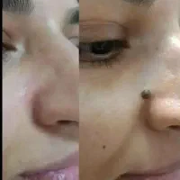 خال زگیل میخچه زگیل تناسلی منگوله گوشتی لیزر
