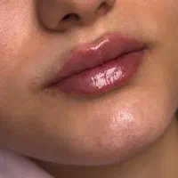 آف ژل بوتاکس مناسبت روز زن|خدمات آرایشگری و زیبایی|ایذه, |دیوار