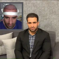 کاشت مو با تراکم بالا فقط با ۸ میلیون پیش‌پرداخت|خدمات آرایشگری و زیبایی|تهران, جردن|دیوار