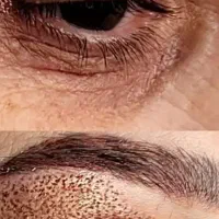 کک و مک،پلاسما،خالبرداری،جوانسازی|خدمات آرایشگری و زیبایی|شیراز, ستارخان|دیوار