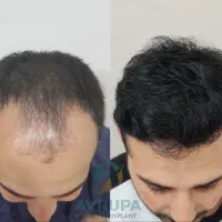 رویش مجدد مو با سرمه ۷ مغز گیاهی